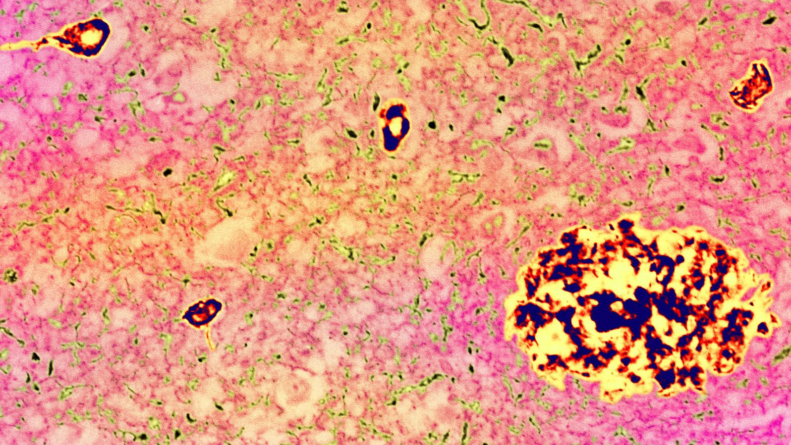 Lecanemab may slow down the progression of Alzheimer's Disease